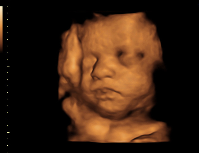 3D ultrasound image at 31 weeks